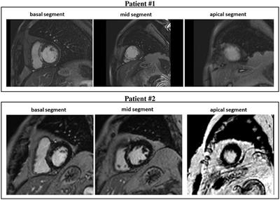 Role of Scar and Border Zone Geometry on the Genesis and Maintenance of Re-Entrant Ventricular Tachycardia in Patients With Previous Myocardial Infarction